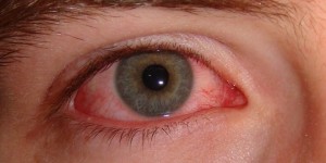 Phòng tránh sự lây lan của đau mắt đỏ 1