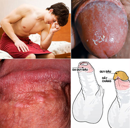 Nguyên nhân gây viêm quy đầu ở nam giới